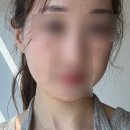 평화한의원 | 부산 서면 새살침 | 여드름 흉터치료 한의원 3회차 찐후기