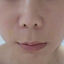 포레스트성형외과의원 | 2025.09.25 부산 팔자주름 필러 후기