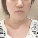 압구정역피부과 울쎄라피프라임 효과 후기, 붓기 멍 비용 솔직하게 정리
