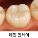 미성치과기공소 | 레진 vs 인레이, 고민 끝! 충치 크기별 치료법부터 비용, 장단점까지 완벽 비교