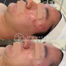 좁쌀여드름 고민이라면 청주 수드림에스테틱 여드름관리