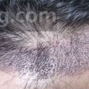 M병원 | M자 모발이식 2000모낭 후기[병원 선택,헤어라인 디자인,초기 사후관리,병원 비용]