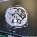 홍익외과의원 | 남편의 담낭 절제술 2화 - 홍익병원에서 이대목동병원으로