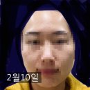 기미잡티크림-센텔루션 시카크림 14일 사용후기