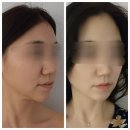 뤼미에르 에스테틱 | 파주피부관리 뤼미에르 에스테틱에서 리프팅 후기