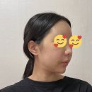 더원외과 | 내돈내산 압구정 더원성형외과에서 PRP지방이식후기 지방이식하고 한달동안 느낀 점