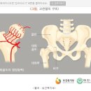 고관절 구조 밎 수술 후유증 이미지