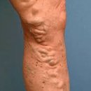 하지정맥류의 치료와 예방 이미지