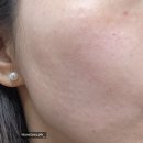 스노우의원 | [청주 스노우의원] 리쥬란hb 2cc 후기