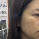 새율하약국 | 김해피부과 편평사마귀 제거후기 듀오덤 교체시기