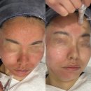 달비아뷰티 | 중랑구 에스테틱, 콤플렉스였던 볼 흉터 케어 받은 달비아뷰티 후기