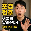 헬스라인 | 포경 전후, 이렇게 달라진다! 실제 후기 기반