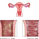 질곰팡이균, 위축성 질염 원인 및 (생식기 질염냉, 질냄새, 질입구 간지러움, 질건조, 질따가움, 질통증, 질에서 덩어리, 질에서피) 이미지