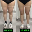 바디리핏 | 허벅지 안쪽살 제거, 왜 안 빠질까? 리핏 바디온다로 해결 (부산 하체관리)