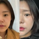 센텀6로 | 센텀피부과 줄기세포 주사 맞고 피부가 바뀐 이유 (내돈내산 6cc 후기)