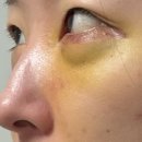 노란문약국 | [💍7] 웨딩일기ㅣ눈밑지 수술 당일 ~ 수술 후 7일(사진 많음/스압 주의)ㅣ내돈내산