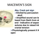 Macewen's sign 매퀴언 징후 이미지