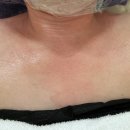 H 메디컬 | 파주 피부관리 H.뷰티리움 모공타이트닝 &amp; 니들프리 V핏 후기