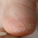 메디레스큐 | 발바닥 각질 무좀 스프레이 추천 메디좀 풋 레스큐 내돈내산