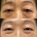 50대 중년 눈밑지 : 하안검 + 눈썹하거상 수술후기 (당일 ~ 수술 12일차)