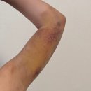 4공단로1L-23 | [ 웨딩관리 추천 ] 팔뚝람스 23일차 후기 (2kg차이지만 확연한 눈바디)