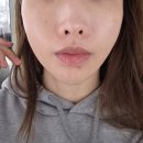 티타늄리프팅 효과 부작용 내돈내산 후기