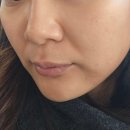 마포구청역 3번 출구 앞 | 마포구청역피부과 브이로어드밴스 - 팔자주름 리프팅 후기