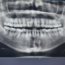 천지사우나헬스 | 치아교정18년후기 큰일선고를 받다..칫솔추천 등