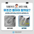 [덕은치과]잇몸까지 번진 치통, 무조건 뽑아야 할까요?(삼성퍼스트치과_재신경치료)