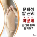 나도손톱 레푸스 개봉점 이미지