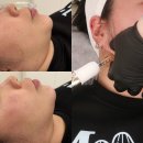 용현초등학교 (옆 도로) | 용현동웨딩관리 이중턱 리프팅 피팅샷 헤이유왁싱스킨 후기