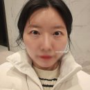 리뉴외과의원 | 강남성형외과 눈밑지방레이저 받고 온 후기 (눈밑지 후유증, 부작용, 통증)
