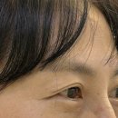 풍국면방촌점 | [대구 쌍꺼풀 후기] 50대 쌍꺼풀 수술 2주차 솔직 후기