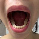 미바른이치과교정과치과의원 | 광양 바른치과 교정상담 후기｜복잡한 치아 정밀검사 본뜨기 비용 25만5천원