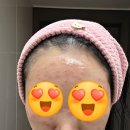 메이퓨어의원 산본점 | [산본]산본 피부과/메이퓨어 피부과/한관종,비립종,쥐젖,점,편평사마귀 제거 2개월차 후기 내돈내산