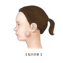 림프관종(Lymphangioma) 질환이란? 이미지