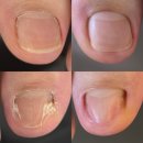 더웰피부과의원 | 대전발톱무좀 고민을 해결할 수 있었던 후기!