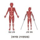 베커형 근이영양증 (Becker Muscular Dystrophy) 이미지