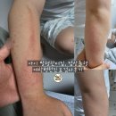 7세 아이 팔 점상출혈 혈관 터짐 대학병원 검사기록 총정리 (6개월 솔직후기)