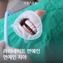 연예인 - 제주시 삼무로 52 | 선릉역 라미네이트 연예인 무삭제 후기 예쁜 치아 믿어도 될까?