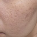 바름한의원 | 도봉구한의원추천 롤링흉터 패인흉터제거 새살침 4회차 시술