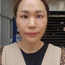 가나이글 | 피부관리고민중인가요??쥬베룩스킨 3회마친 후기~~내돈내산ft.스컬트라(후기포함)와 쥬베룩볼륨 ,필러 비교