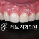 유일교정 치과기공소 | 신사역 라미네이트, 잘하는 치과의 치료과정과 재료.설명.비용.후기.