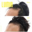 루미아스칼프 | 구미탈모관리 루미아스칼프 두피관리 후기: 자연스러움으로 변화된 나