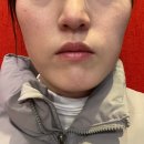 기린성형외과의원 | 기린성형외과 갸름주사 지방분해주사 1회차 후기