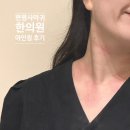 안의한의원 | [강남역 한의원] 목 편평사마귀 제거 내돈내산 후기: 아인침으로 흔적 없이 매끈해진 변화 (듀오덤없이...