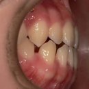 락 궁 | 온양온천역치과, 앞니 사이 벌어짐과 3급 부정교합이 동시에? 데이몬 교정기 치료 후기 케이스