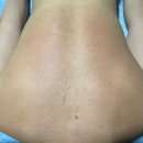 라엘약국 | 강남 남자등드름 알라딘필링 전문 [라엘보떼] 1회 효과 후기