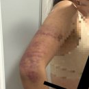 멍이요 천안지점 | 천안 팔뚝 무한람스 내돈내산 3주차 후기