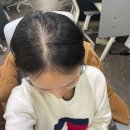 4612 | <대전 두피문신> 탈모 초기에 두피문신으로 커버 가능할까 ? (고객님 실제 사례)